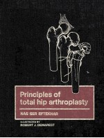 principles of total hip arthroplasty