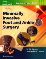 MINIMAIIY INVASIVE FOOT AND ANKIE SURGERY