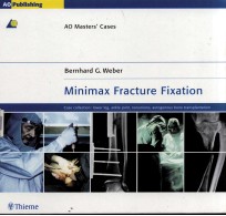 MINIMAX FRACTURE FIXATION