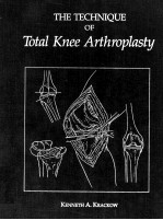 THE TECHNIQUE OF TOTAL KNEE ARTHROPLASTY